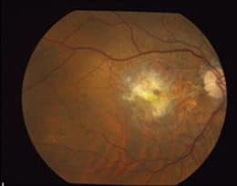 Chronic Wet AMD with Macular Scarring