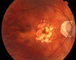 Dry AMD with Atrophy