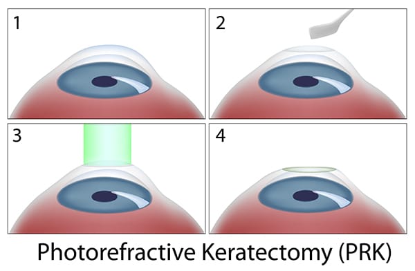 PRK steps diagram