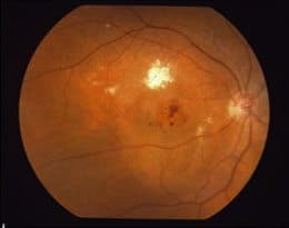 Wet AMD with Swelling and Hemorrhages